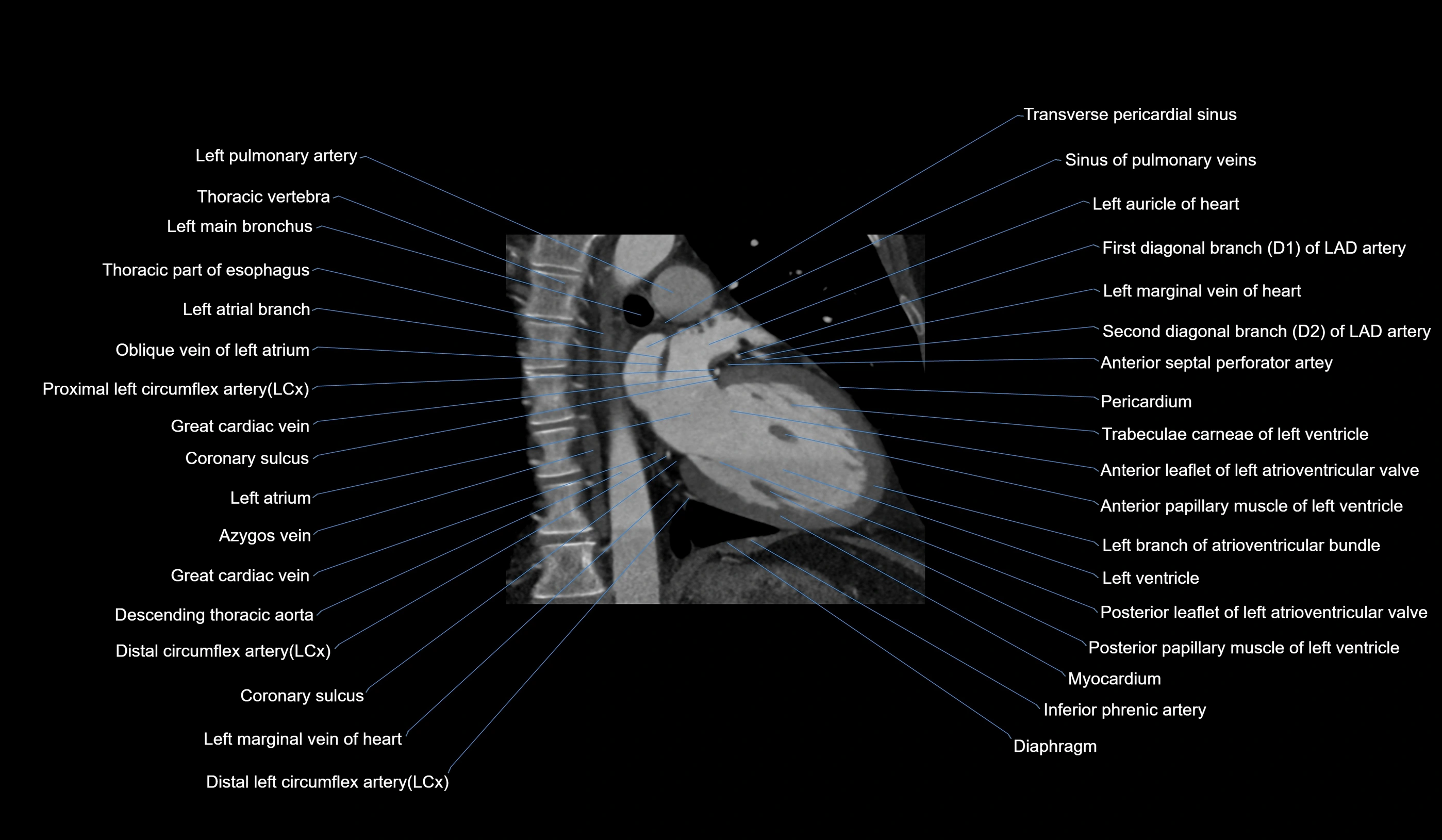 CT heart (coronary angiogram) 2 chamber view cross sectional anatomy labelled radiology image-00012.webp